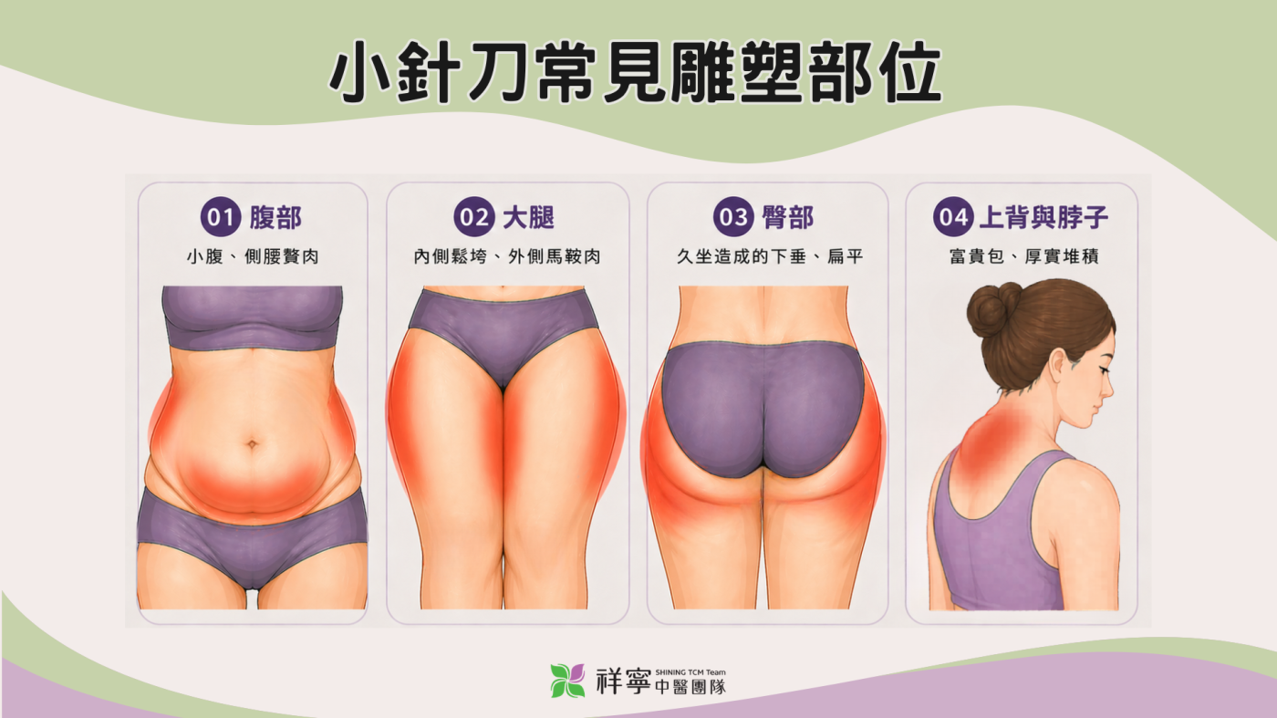 小針刀減肥部位圖解：改善腹部、大腿馬鞍肉、臀部與背部富貴包。