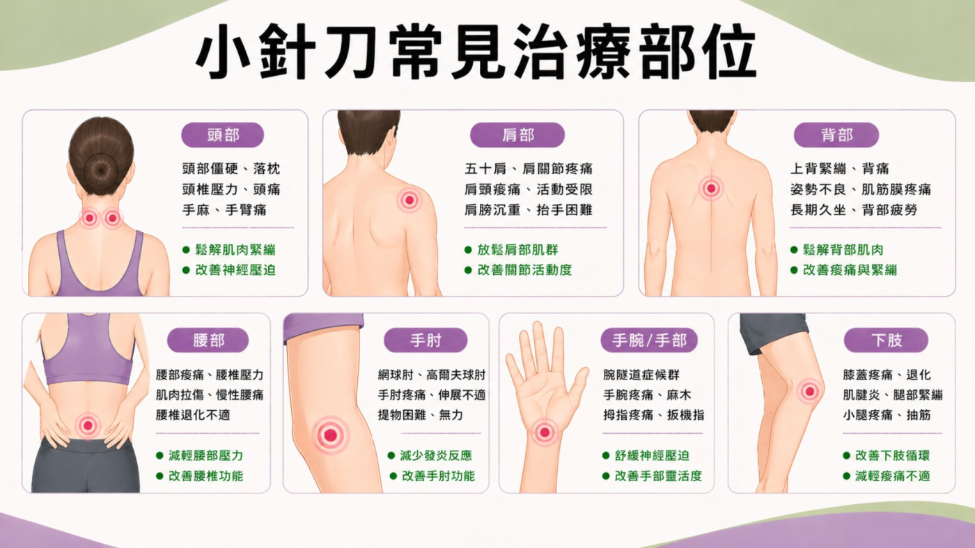 小針刀常見治療部位圖解：包含頭頸、肩背、腰部及手足關節等臨床適應症解析。