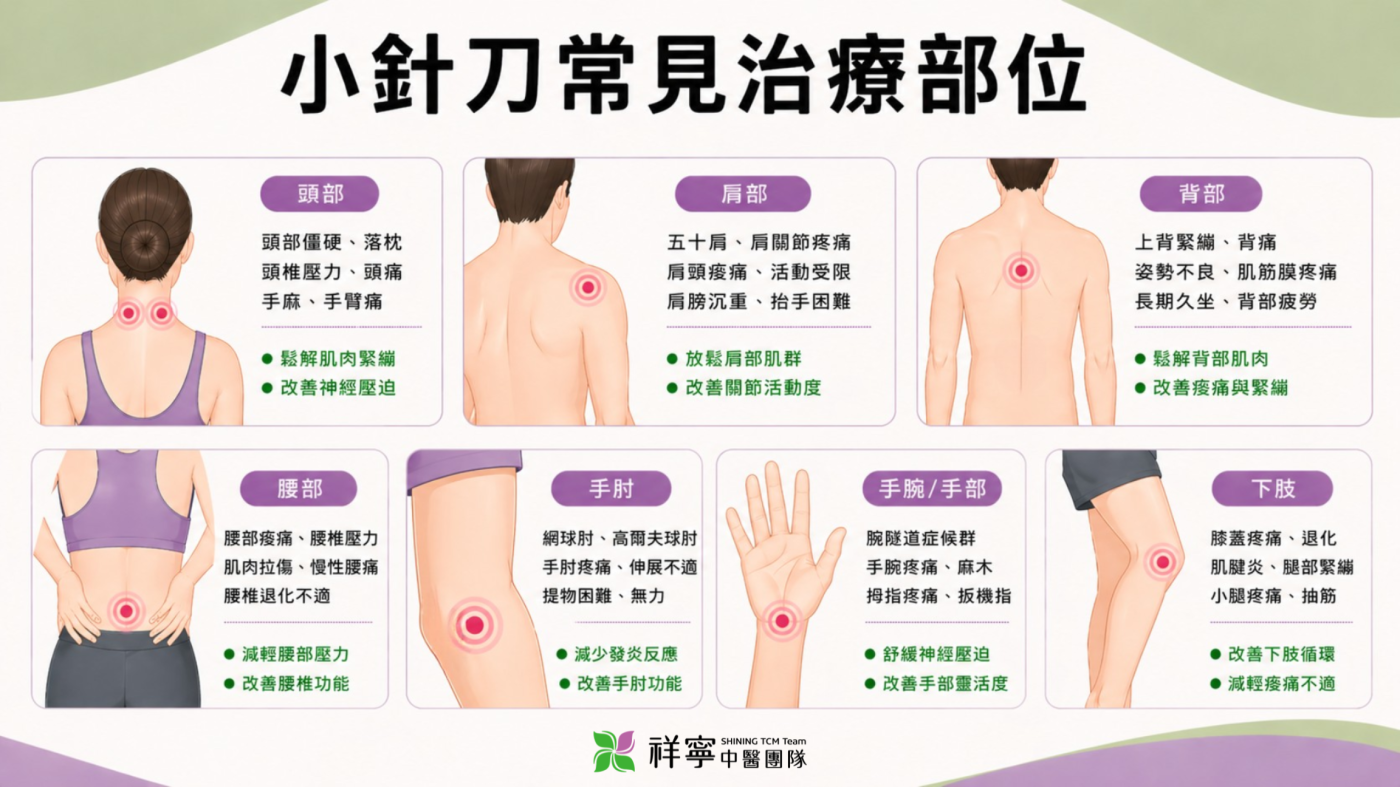 小針刀常見治療部位圖解：包含頭頸、肩背、腰部及手足關節等臨床適應症解析。