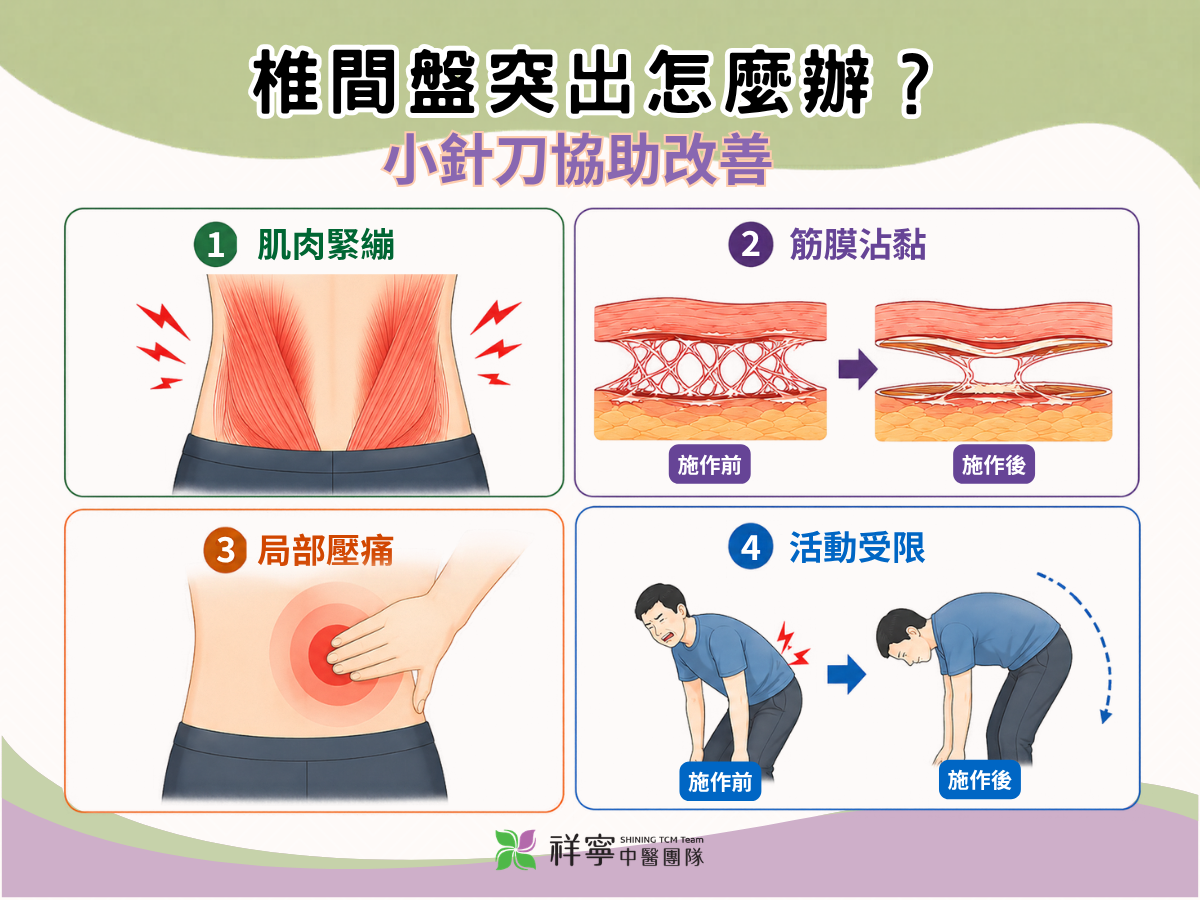 椎間盤突出小針刀評估說明圖，整理肌肉緊繃、筋膜沾黏、局部壓痛與活動受限等改善方向。