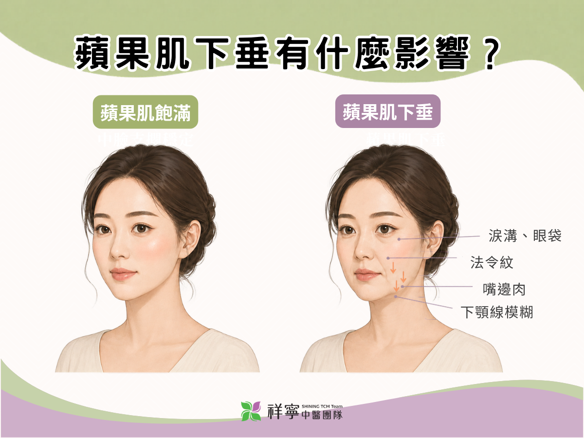 蘋果肌下垂可能伴隨淚溝眼袋、法令紋、嘴邊肉與下顎線模糊
