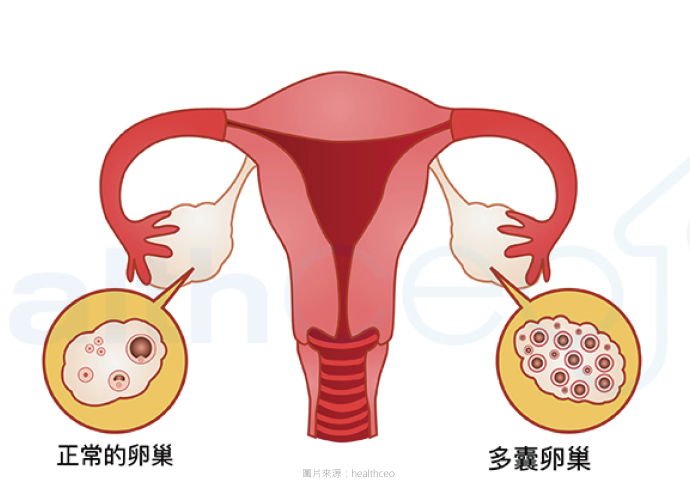 認識多囊卵巢症（上）