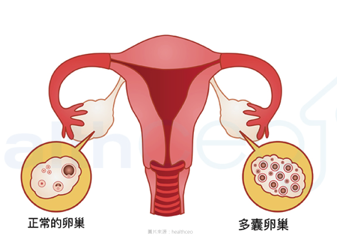多囊性卵巢的治療（下）