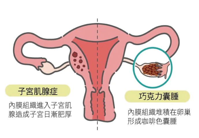了解巧克力囊腫原因、症狀與治療方式