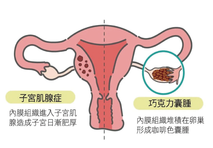 認識巧克力囊腫（上）