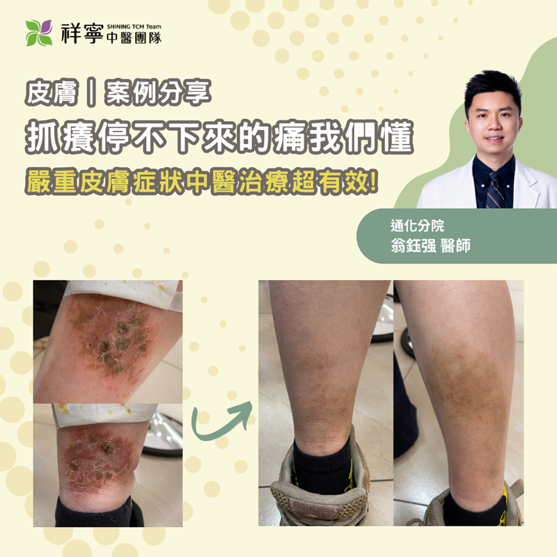 告別搔癢！中醫治皮膚超有效