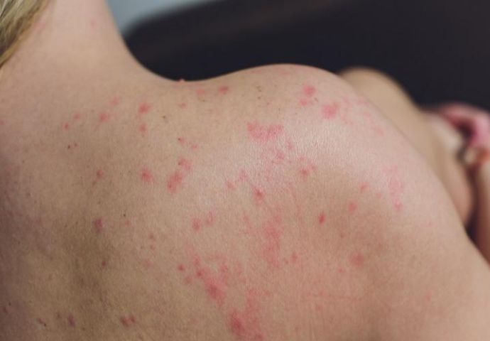 皮膚長濕疹原因有哪些？該怎麼辦？解密中西醫治療方式與常見問題